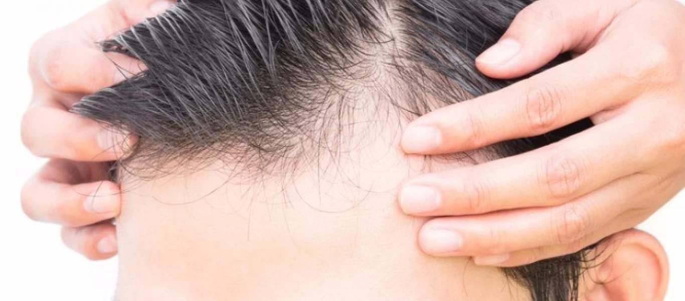 Τριχόπτωση: To λαχανικό που θα σας βοηθήσει να την καταπολεμήσετε